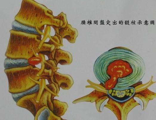 患腰椎间盘突出在饮食上要注意什么?