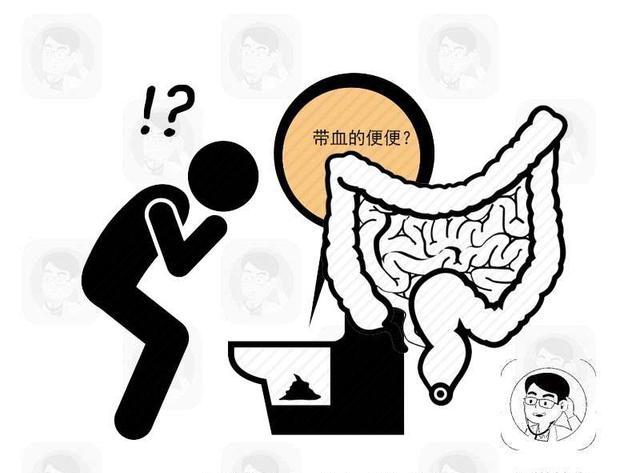 血便并不是肠癌的早期表现,虽说大肠癌早期同样可能会出血,但由于出血