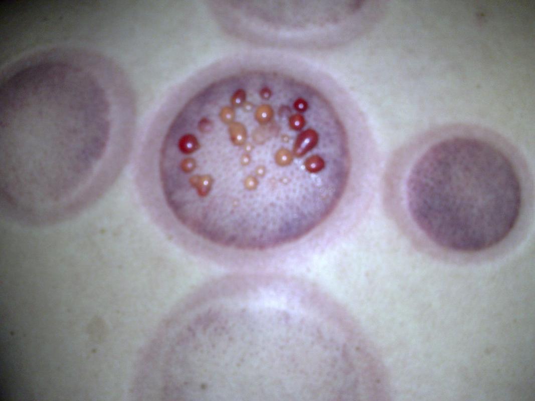 拔火罐拔成这样是怎么回事?严重吗?背部脊椎的位置.