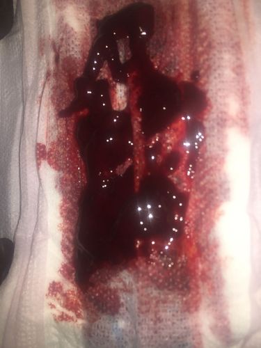 大姨妈十天前来了…现在又来了…流好多血. 还有好多一坨一坨是什么鬼