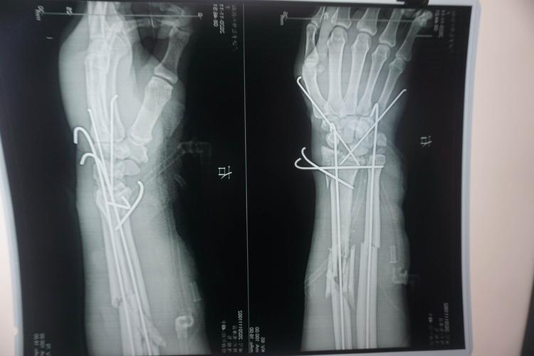 一期修复神经血管,肌腱,彻底清创,尺桡骨及腕部克氏针固定!