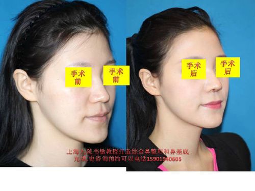 综合隆鼻整形,鼻基底充填,手术前后照片对比
