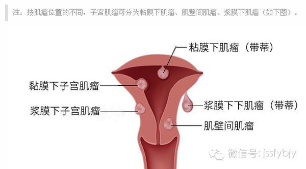 怀孕遇上子宫肌瘤!别崩溃,这里有你想知道的答案!