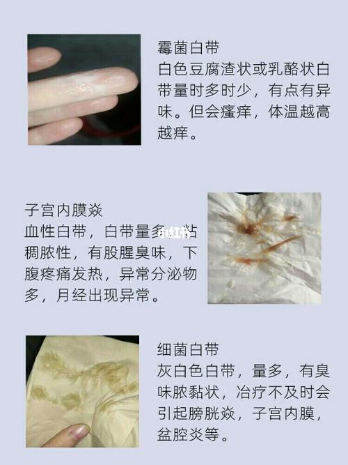 被滴虫白带反复折磨,真的是怕怕的 滴虫白带阴焱真的给我整怕了,女孩