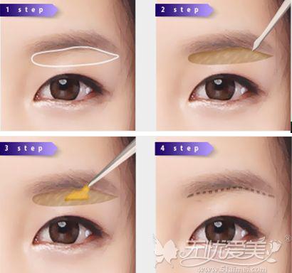 眼角提拉手术怎么做能让你恢复青春神采飞扬