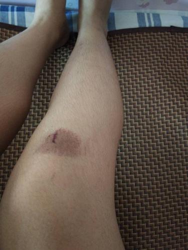 膝盖摔伤了怎么办