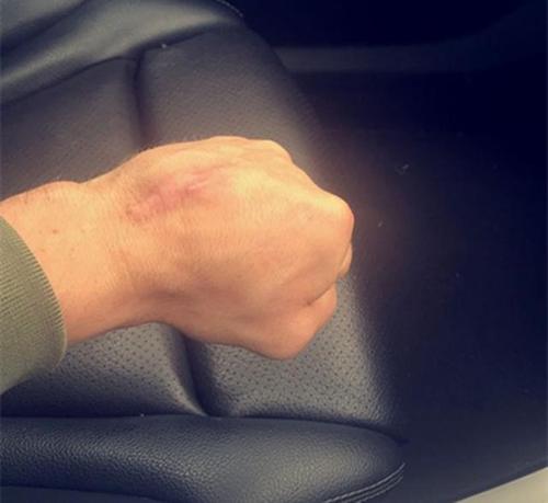 最特殊的奥运拳王!把臀骨移植到拳头,网友:真正的一屁股锤死你