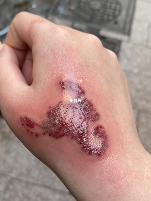 或者就是去纹身店使用点阵一次消除皮肤沉淀物,期待消肿结痂的效果