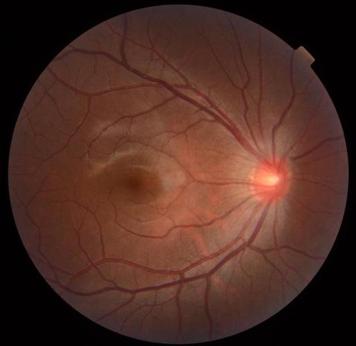 名医话健康|糖尿病视网膜病变——"甜蜜"的负担