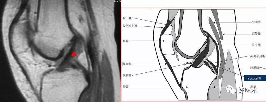 标记:高尔夫球杆形状—外侧层面 标记:不要认为是半月板前角的碎片 矢