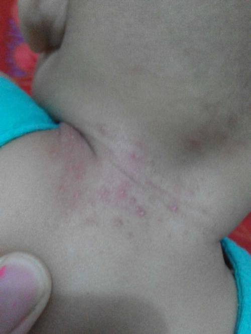 不知道怎么了小孩子脖子后面长点小疙瘩?