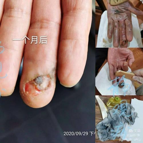 李氏砭法|砭治糖尿病坏疽(手指)