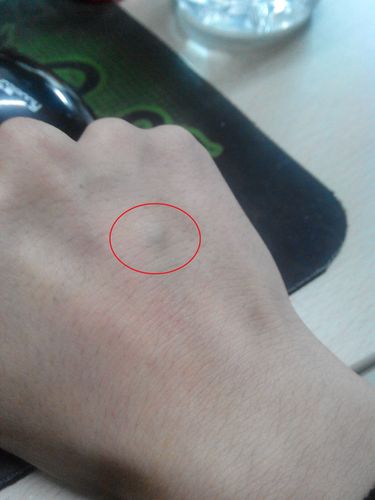 手背血管鼓起来一片,是怎么了?
