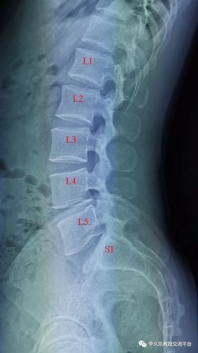 骶骨的形状有些勉强,是否以往有过骨折所致的畸形?