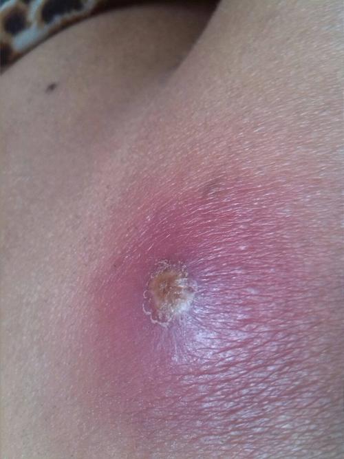 屁股上长这个疙瘩,一开始以为是粉刺挤了一下,过两天就严重了,后来去