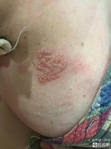 孕期6个月,老婆胸前咯吱窝后背生蛇,一种皮肤病