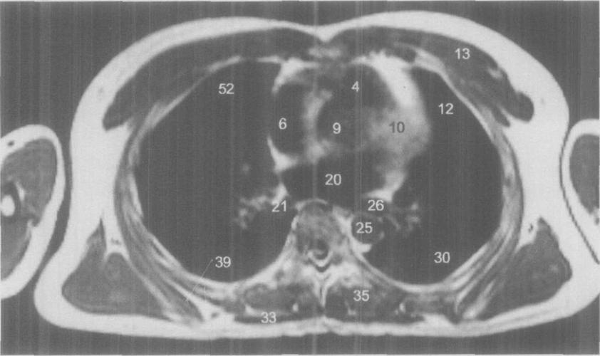 图512经左右下肺静脉的横断层