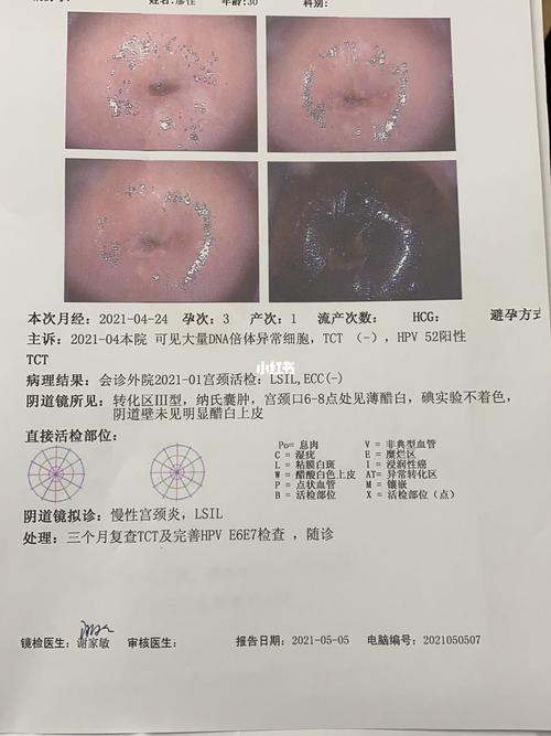 hpv52型感染两年了,大量异常细胞_hpv_炎症_医疗健康