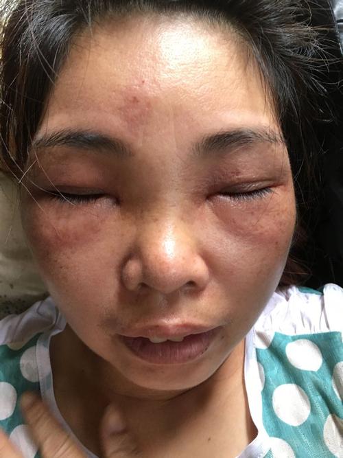 今天整个脸部由上往下都肿起来了