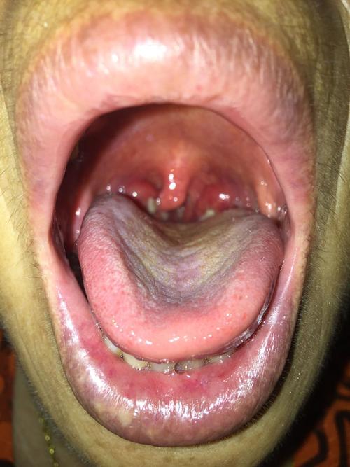 了后来又说喉咙疼一看里面竟然有白色的脓包一样的东西求解这是什么