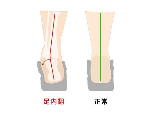 你是否有足内翻