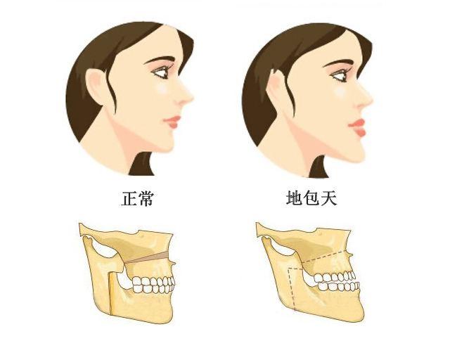 青少年骨性反颌可以矫正吗?