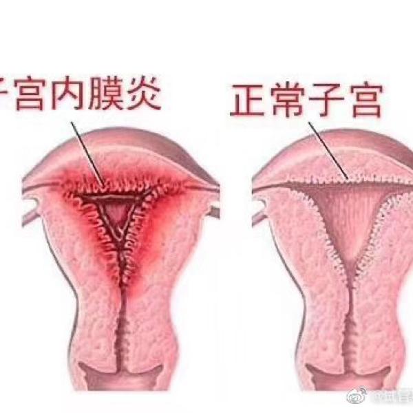 影响做试管吗? 细菌侵犯子宫内膜使之发炎