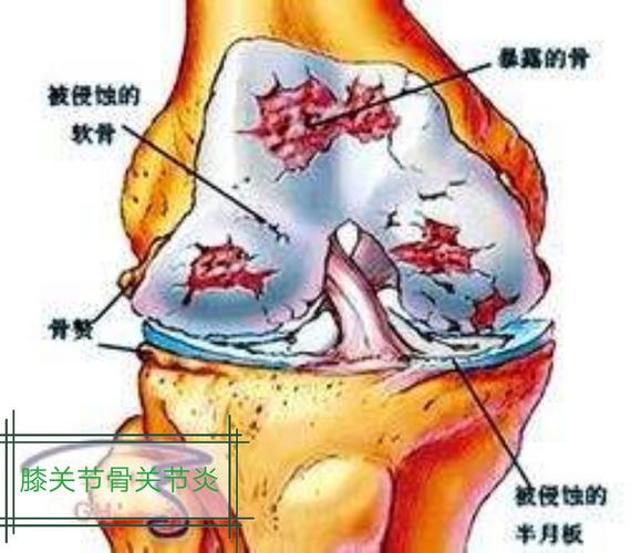 膝关节骨性关节炎示意图