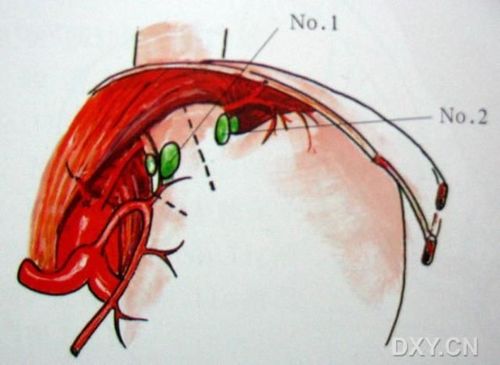  2.贲门左淋巴结:沿左膈下动脉贲门食管支分布.