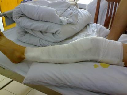 单纯前交叉韧带重建后康复