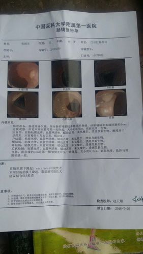 距肛门缘4厘米直肠粘膜下良性肿瘤,能做了微创手术吗