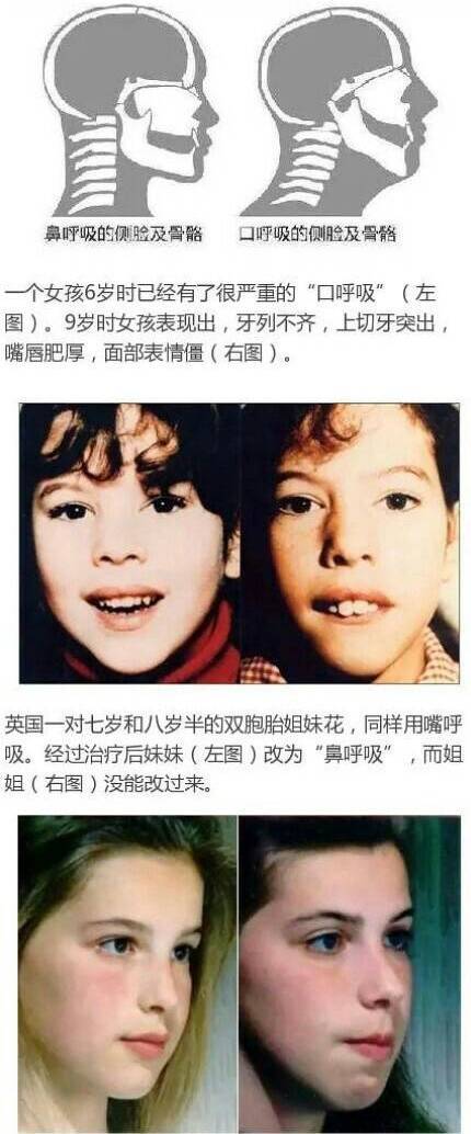 17岁女,因为有鼻炎一直是口呼吸.
