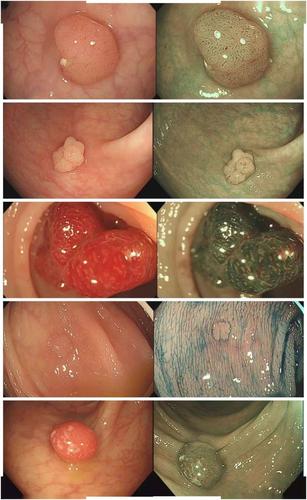【肠健课堂】结肠息肉——不能忽视的小问题