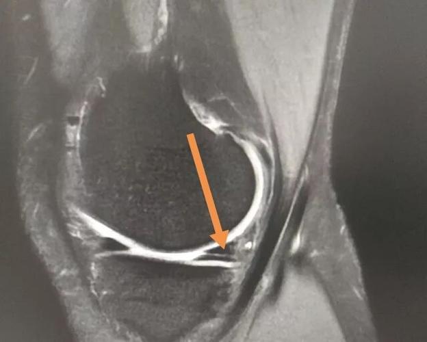 半月板损伤如何治疗