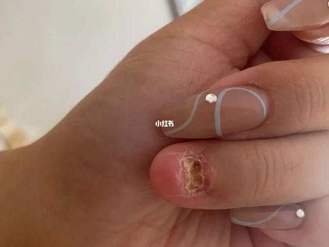 指甲全翻过去——不喜勿点图_凡士林怎么样_拔甲_医疗