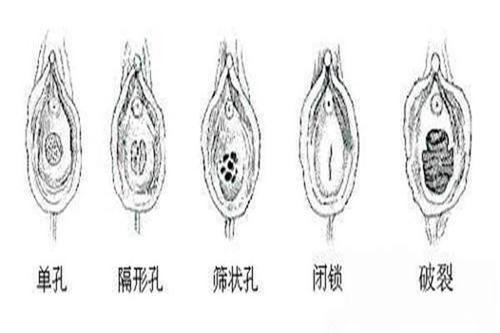 什么是石女?石女有什么症状吗