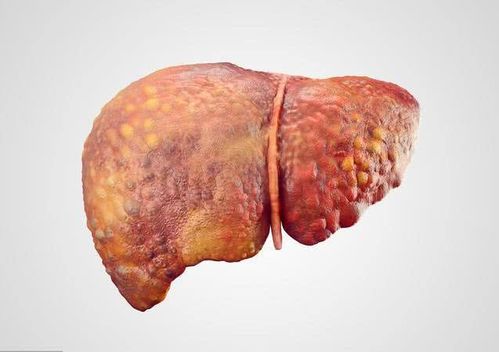 肝癌早期,肩膀出现1种痛感,说明有癌细胞了