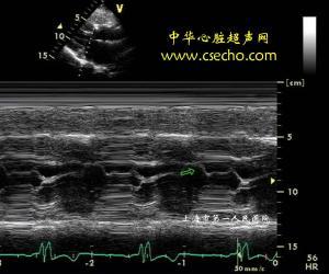 肥厚型心肌病超声心电图
