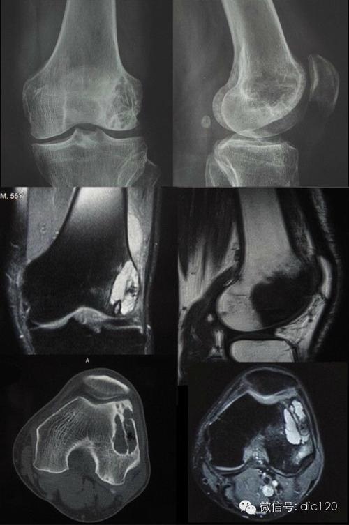 骨内腱鞘囊肿(邻关节骨囊肿)