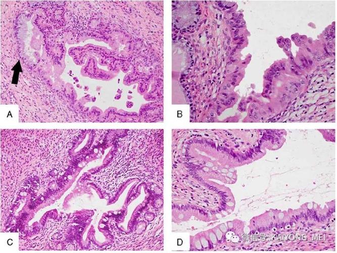 根据组织形态学特点不同,将非普通型原位腺癌分为肠型,胃型,子宫内膜