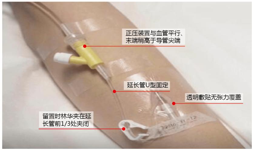 降低留置针回血发生率小妙招