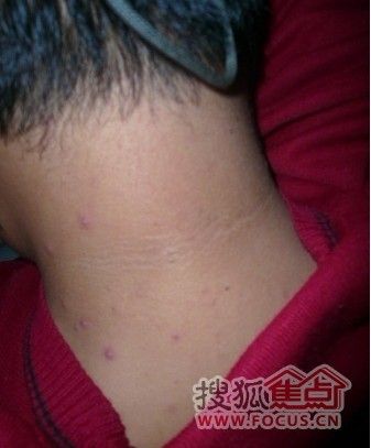 艾滋病的临床症状多种多样,一般初期