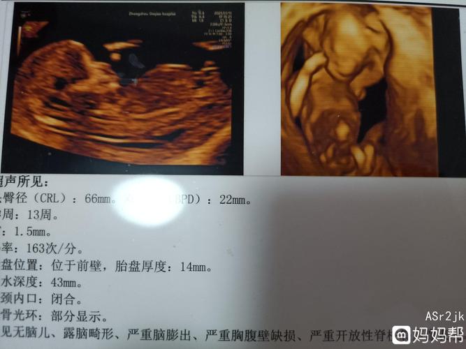 孕14周,同一天b超查了两家