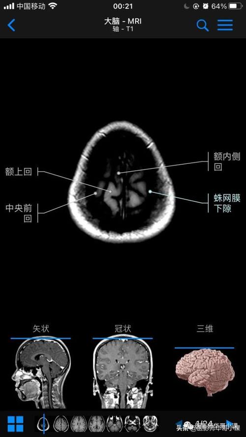 高清mri图颅脑磁共振mri解剖