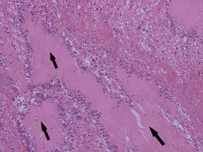 混合血栓_病理标本博物馆-复旦大学基础医学院