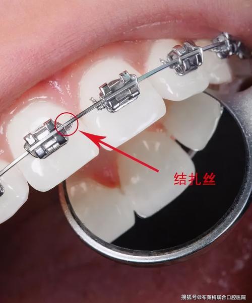 无托槽隐形矫治器:一种计算机辅助设计和制作的透明弹性材料活动矫正
