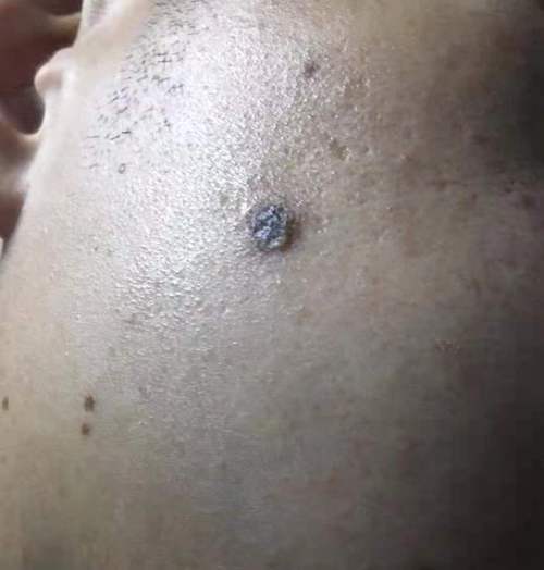 病毒疣面部寻常疣一枚成功消灭
