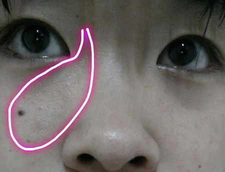 我眼角处的小痘痘还有我眼角鼻子上的 是脂肪粒还是闭口还是白头?