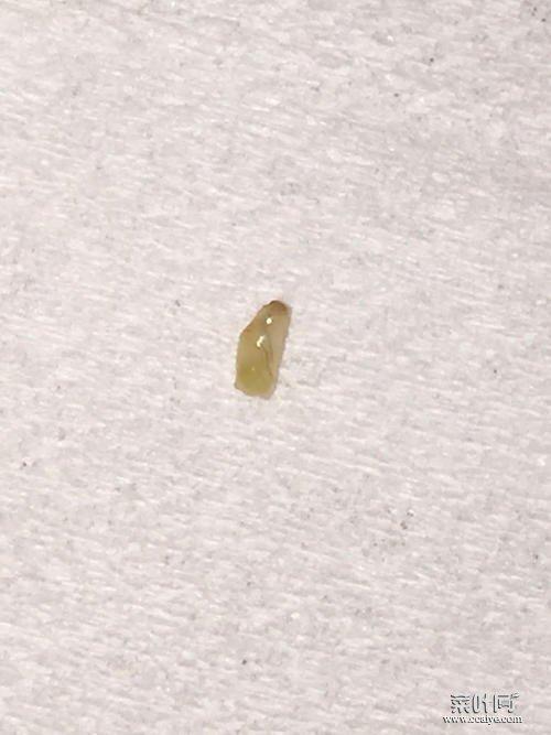 从脸上挤出来的螨虫图脸上挤出来的透明米粒是螨虫吗