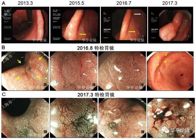 一个胃角的癌变之路